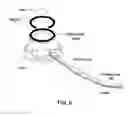 Fig. 07 - MAGNETICALLY-LOCALIZABLE IMPLANTED HEMODIALYSIS VASCULAR ACCESS DEVICES, AND METHODS FOR IMPROVING THE CANNULATION THEREOF