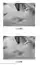 Fig. 09 - MAGNETICALLY-LOCALIZABLE IMPLANTED HEMODIALYSIS VASCULAR ACCESS DEVICES, AND METHODS FOR IMPROVING THE CANNULATION THEREOF