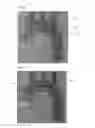 Fig. 02 - Embolic filter device and method of use thereof