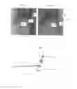 Fig. 04 - Embolic filter device and method of use thereof