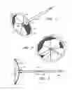 Fig. 02 - SYSTEM FOR LEFT ATRIAL APPENDAGE OCCLUSION