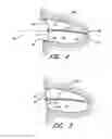 Fig. 04 - SYSTEM FOR LEFT ATRIAL APPENDAGE OCCLUSION