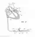 Fig. 06 - SYSTEM FOR LEFT ATRIAL APPENDAGE OCCLUSION