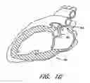 Fig. 07 - SYSTEM FOR LEFT ATRIAL APPENDAGE OCCLUSION