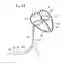 Fig. 02 - Expandable clip for tissue repair