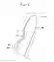 Fig. 04 - Expandable clip for tissue repair