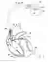 Fig. 06 - Method for hemodynamic optimization using plethysmography