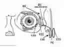 Fig. 01 - RETINAL PROSTHESIS