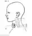 Fig. 08 - Devices and methods for non-invasive electrical stimulation and their use for vagal nerve stimulation on the neck of a patient