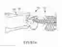 Fig. 52 - Systems for and methods of fusing a sacroiliac joint