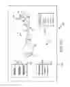 Fig. 86 - Systems for and methods of fusing a sacroiliac joint