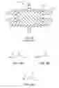 Fig. 06 - Anatomy accomodating prosthetic intervertebral disc with lower height