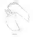 Fig. 15 - Systems and methods for providing deeper knee flexion capabilities for knee prosthesis patients