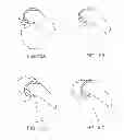 Fig. 16 - Systems and methods for providing deeper knee flexion capabilities for knee prosthesis patients
