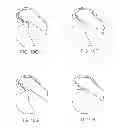 Fig. 17 - Systems and methods for providing deeper knee flexion capabilities for knee prosthesis patients