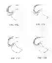 Fig. 19 - Systems and methods for providing deeper knee flexion capabilities for knee prosthesis patients