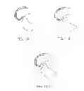 Fig. 20 - Systems and methods for providing deeper knee flexion capabilities for knee prosthesis patients