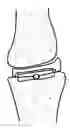 Fig. 01 - Patient selectable knee arthroplasty devices