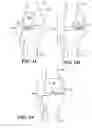 Fig. 19 - Patient selectable knee arthroplasty devices