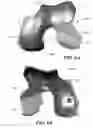 Fig. 20 - Patient selectable knee arthroplasty devices