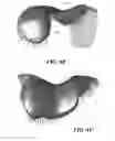 Fig. 22 - Patient selectable knee arthroplasty devices