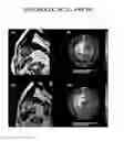 Fig. 03 - Rapid infusion of autologous bone marrow derived stem cells