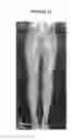 Fig. 04 - Rapid infusion of autologous bone marrow derived stem cells