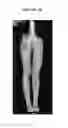 Fig. 05 - Rapid infusion of autologous bone marrow derived stem cells