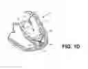 Fig. 03 - Therapeutic methods and devices following myocardial infarction