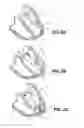 Fig. 04 - Therapeutic methods and devices following myocardial infarction