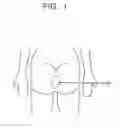 Fig. 02 - Apparatus and method for removing a foreign object from a rectal cavity