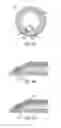 Fig. 03 - Ophthalmic lens with a microfluidic system