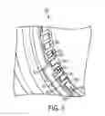 Fig. 06 - Ophthalmic lens with a microfluidic system