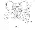 Fig. 02 - Patient-specific surgical guidance tool and method of use