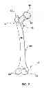 Fig. 03 - Patient-specific surgical guidance tool and method of use