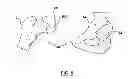 Fig. 07 - Patient-specific surgical guidance tool and method of use