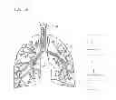 Fig. 02 - DEVICES AND METHODS FOR PERFORMING MEDICAL PROCEDURES IN TREE-LIKE LUMINAL STRUCTURES