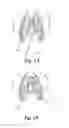 Fig. 02 - Method for puncturing the pericardial membrane by synchronizing needle advancement with cardiac muscle motion