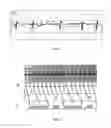 Fig. 02 - System and Computer Program Product for Automatically Distinguishing Atrial Flutter from Atrial Fibrillation