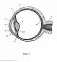 Fig. 02 - Fluid infusion methods for ocular disorder treatment