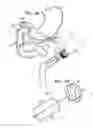 Fig. 06 - PANCREATIOBILIARY DIVERSION DEVICE