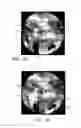 Fig. 04 - Paranasal ostium finder devices and methods