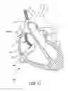 Fig. 16 - System and method for positioning implantable medical devices within coronary veins