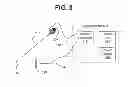 Fig. 03 - Electrical treatment of bronchial constriction