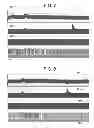 Fig. 06 - Electrical treatment of bronchial constriction