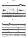 Fig. 08 - Electrical treatment of bronchial constriction