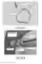 Fig. 07 - Methods and apparatus for magnet-induced compression anastomosis between adjacent organs
