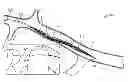 Fig. 01 - Method and apparatus for occlusion removal