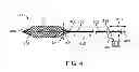 Fig. 20 - Method and apparatus for occlusion removal