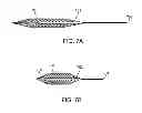 Fig. 24 - Method and apparatus for occlusion removal